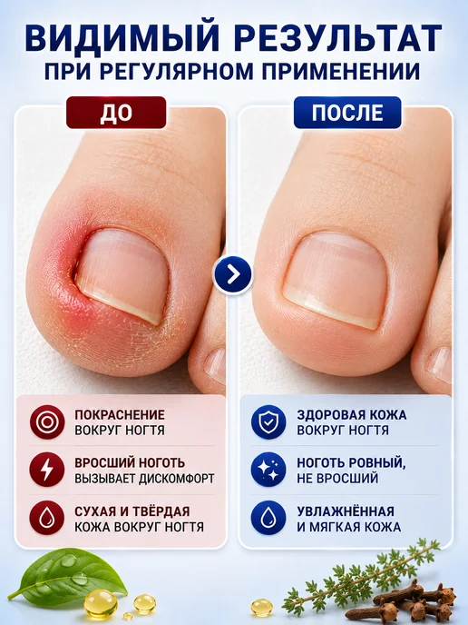 Fortera2 Средство от вросших ногтей на ногах и воспаления, вариант, фото 3