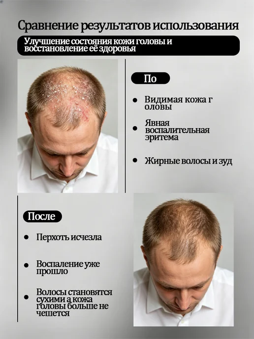 Мужской шампунь от перхоти и жирности кожи головы, вариант, фото 5